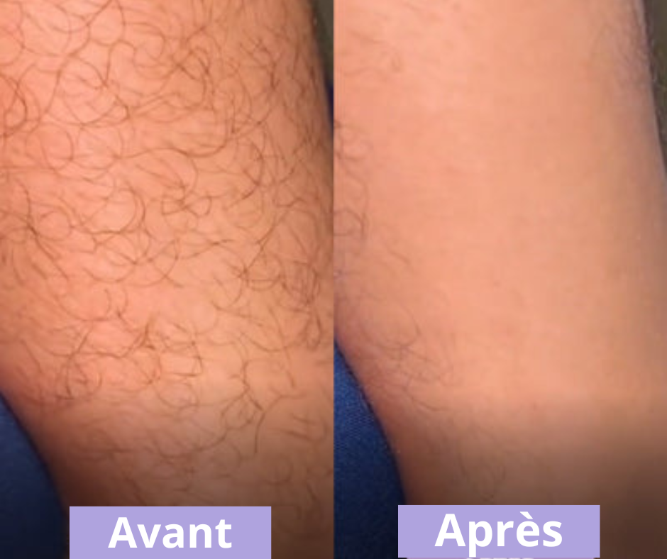 Gomme Magique — Épilation Douce & Peau Soyeuse
